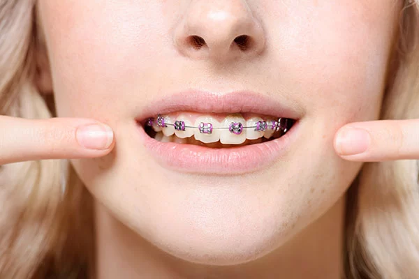 How to Deal with Mouth Sores from Braces: Effective Tips and Treatment Solutions