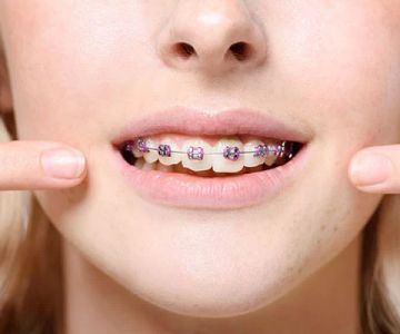 How to Deal with Mouth Sores from Braces: Effective Tips and Treatment Solutions