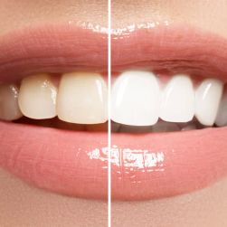 The Importance of Routine Teeth Whitening for Healthy, White Teeth: Essential Tips for a Brighter Smile