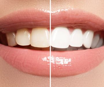 The Importance of Routine Teeth Whitening for Healthy, White Teeth: Essential Tips for a Brighter Smile