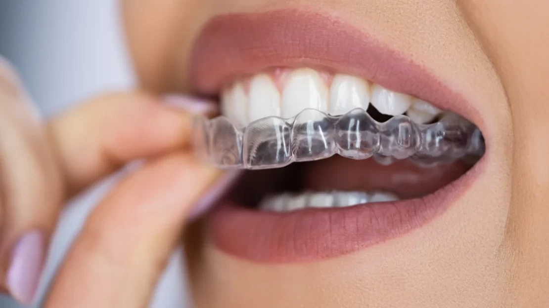 Can I Use Invisalign for My Teeth? Understanding Clear Aligners and Their Benefits