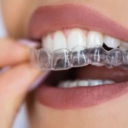 Can I Use Invisalign for My Teeth? Understanding Clear Aligners and Their Benefits