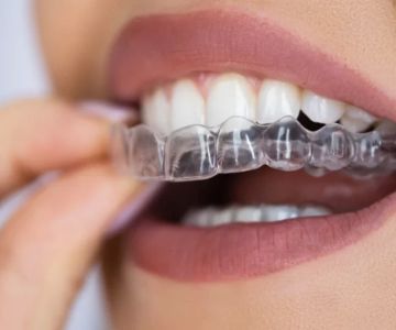 Can I Use Invisalign for My Teeth? Understanding Clear Aligners and Their Benefits