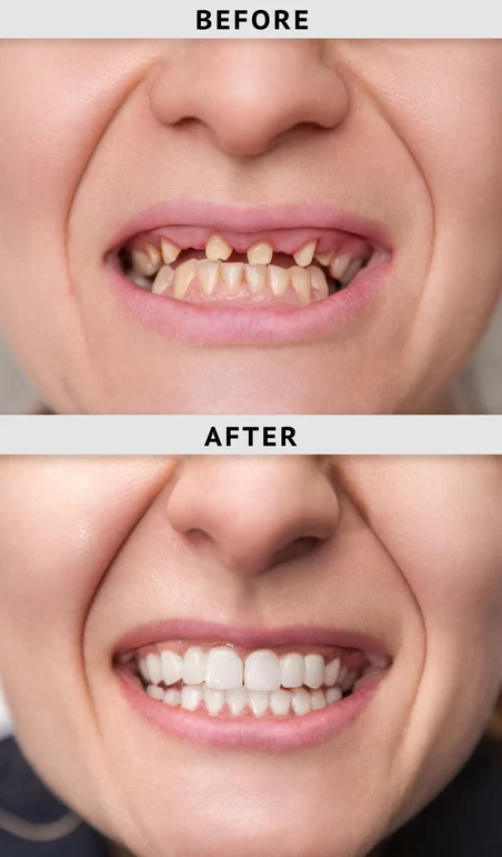Full-Mouth Dental Restoration for Missing Teeth: Solutions and Benefits