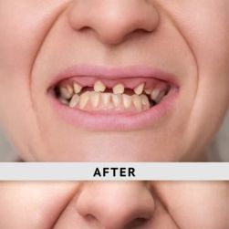 Full-Mouth Dental Restoration for Missing Teeth: Solutions and Benefits