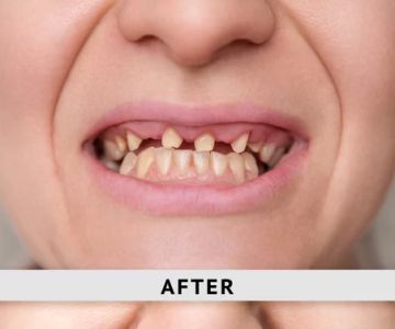 Full-Mouth Dental Restoration for Missing Teeth: Solutions and Benefits