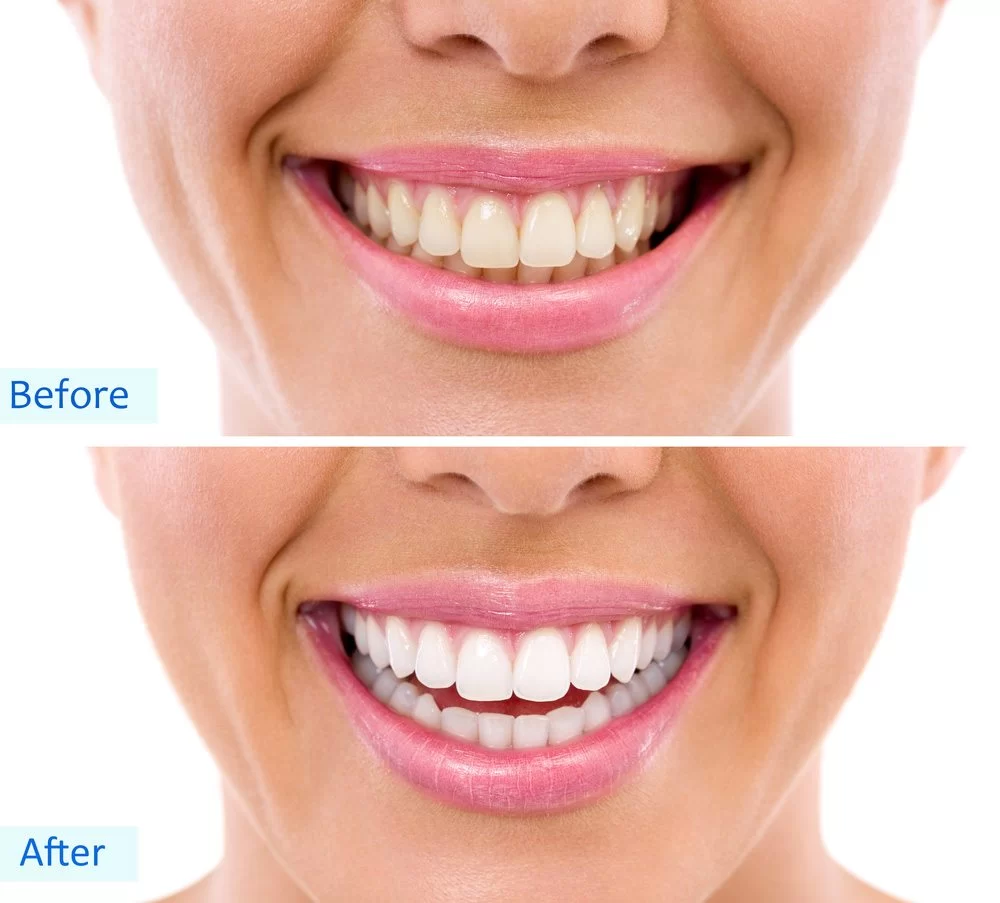 Can Teeth Whitening Cause Sensitivity? Causes, Prevention, and Solutions