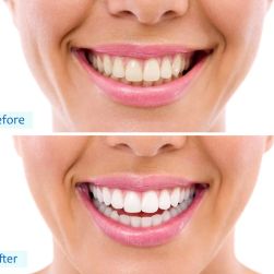Can Teeth Whitening Cause Sensitivity? Causes, Prevention, and Solutions