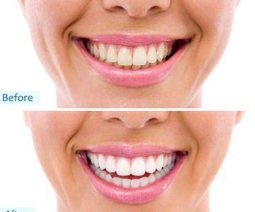 Can Teeth Whitening Cause Sensitivity? Causes, Prevention, and Solutions