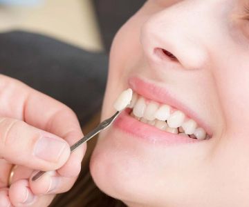 Can Dental Veneers Be Repaired? Everything You Need to Know