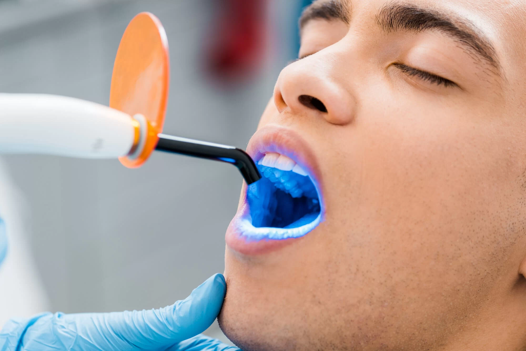 The Benefits of Professional Teeth Whitening Over Home Kits: Why Choose a Dentist?