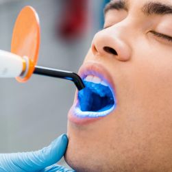 The Benefits of Professional Teeth Whitening Over Home Kits: Why Choose a Dentist?