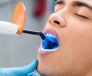 The Benefits of Professional Teeth Whitening Over Home Kits: Why Choose a Dentist?