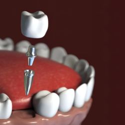 Understanding the Success Rate of Dental Implants: Insights and Real-Life Stories