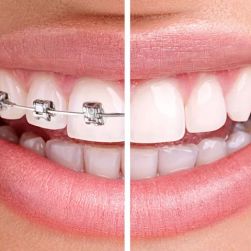How Long Do Braces Take to Straighten Teeth? A Complete Guide