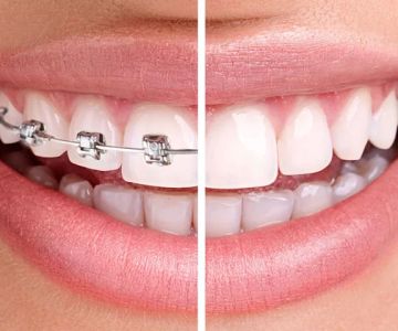 How Long Do Braces Take to Straighten Teeth? A Complete Guide