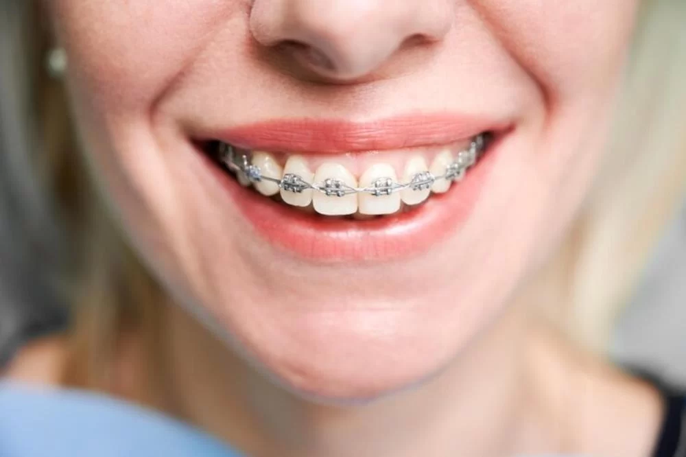 What Are the Types of Braces Available? Explore Your Orthodontic Options