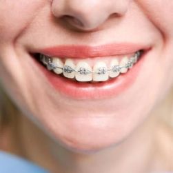 What Are the Types of Braces Available? Explore Your Orthodontic Options
