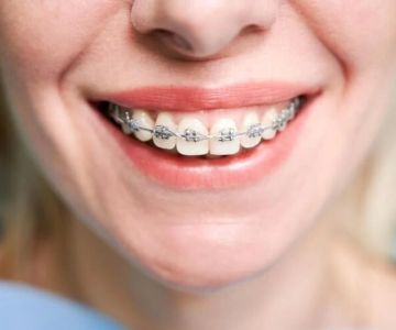 What Are the Types of Braces Available? Explore Your Orthodontic Options