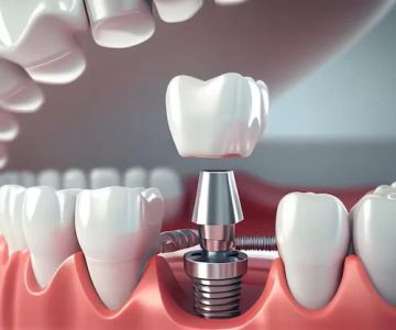 How to Improve the Longevity of Dental Implants: Essential Care Tips