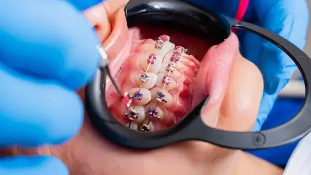 How to Restore a Smile with Dental Bridges: A Complete Guide to Reviving Your Smile