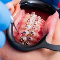 How to Restore a Smile with Dental Bridges: A Complete Guide to Reviving Your Smile