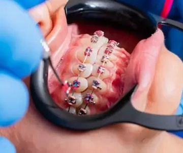 How to Restore a Smile with Dental Bridges: A Complete Guide to Reviving Your Smile