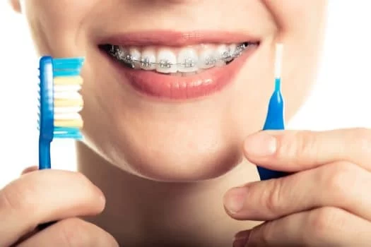 The Ultimate Guide on How to Clean Your Braces: Tips and Techniques