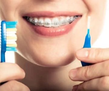 The Ultimate Guide on How to Clean Your Braces: Tips and Techniques