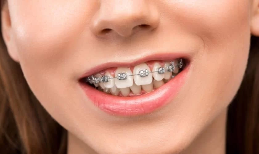 How Do Braces Straighten Teeth? The Science Behind Orthodontic Treatment