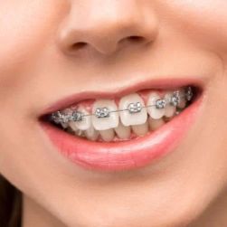 How Do Braces Straighten Teeth? The Science Behind Orthodontic Treatment