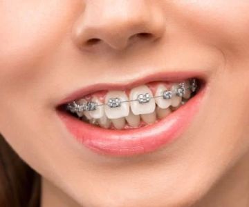 How Do Braces Straighten Teeth? The Science Behind Orthodontic Treatment