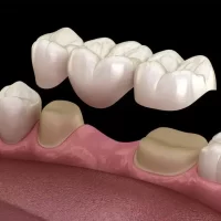 What is a Dental Bridge and How Does it Work? A Comprehensive Guide