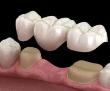 What is a Dental Bridge and How Does it Work? A Comprehensive Guide