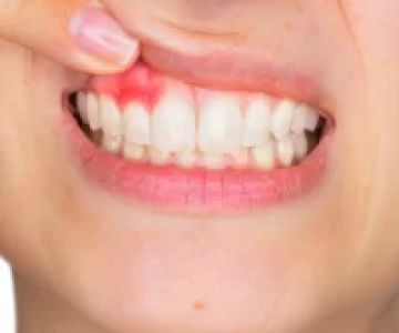 What Are the Signs of a Dental Abscess? Understanding the Symptoms and Treatment Options