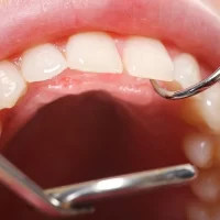 How to Avoid Tooth Decay in Your 30s: Tips for Maintaining a Healthy Smile