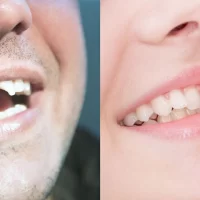 Cosmetic Bonding for Chipped Teeth: A Comprehensive Guide