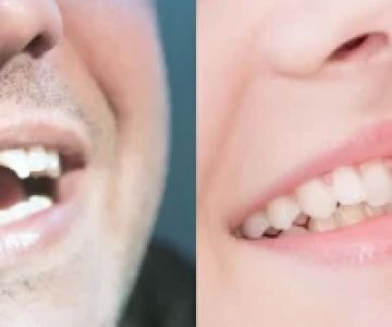 Cosmetic Bonding for Chipped Teeth: A Comprehensive Guide