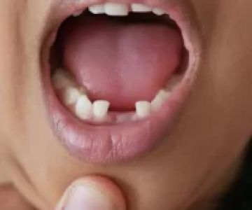 The Best Treatment for a Knocked-Out Tooth: What You Need to Know to Save Your Tooth