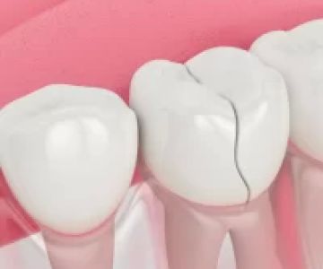 Immediate Solutions for Cracked Dental Restorations: Quick Fixes and Professional Care