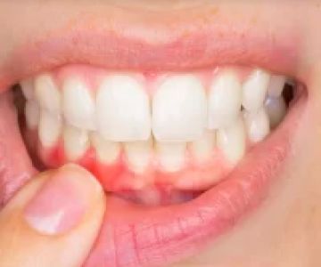 Causes of Periodontal Disease and How to Prevent It
