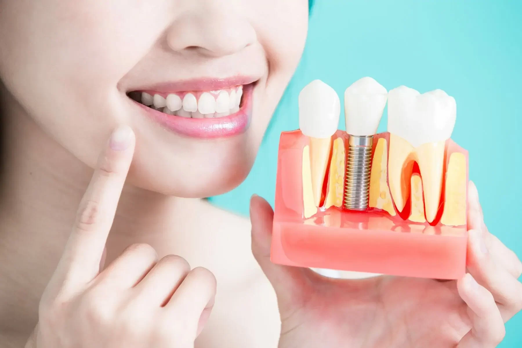 How Long Does It Take for Dental Implants to Heal? A Complete Guide