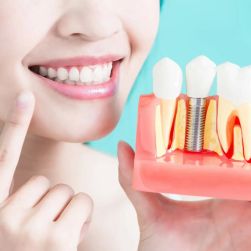 How Long Does It Take for Dental Implants to Heal? A Complete Guide
