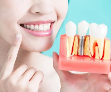 How Long Does It Take for Dental Implants to Heal? A Complete Guide