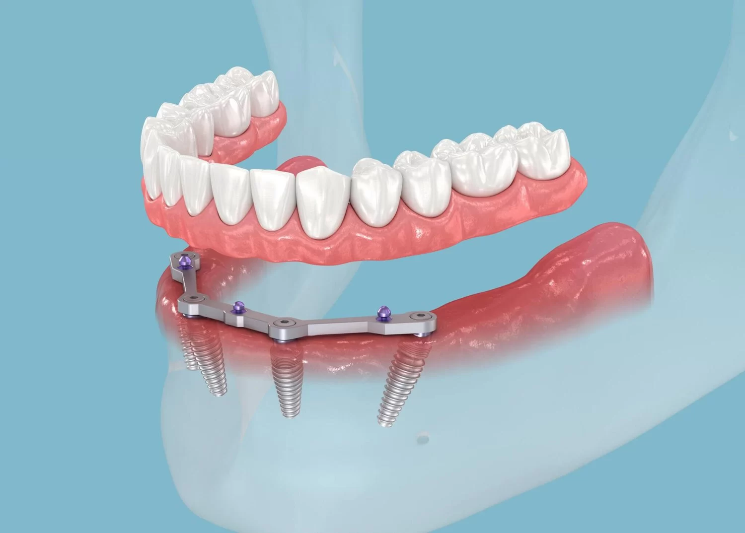 How Do Dental Implants Help with Tooth Loss? A Comprehensive Guide