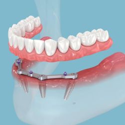 How Do Dental Implants Help with Tooth Loss? A Comprehensive Guide