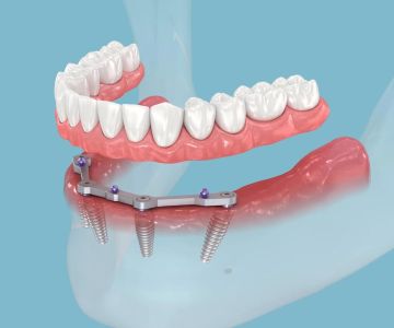 How Do Dental Implants Help with Tooth Loss? A Comprehensive Guide