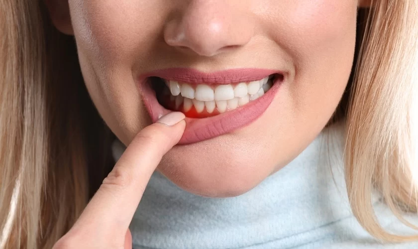 How Do You Treat Gum Disease Naturally? Effective and Simple Remedies for Healthy Gums