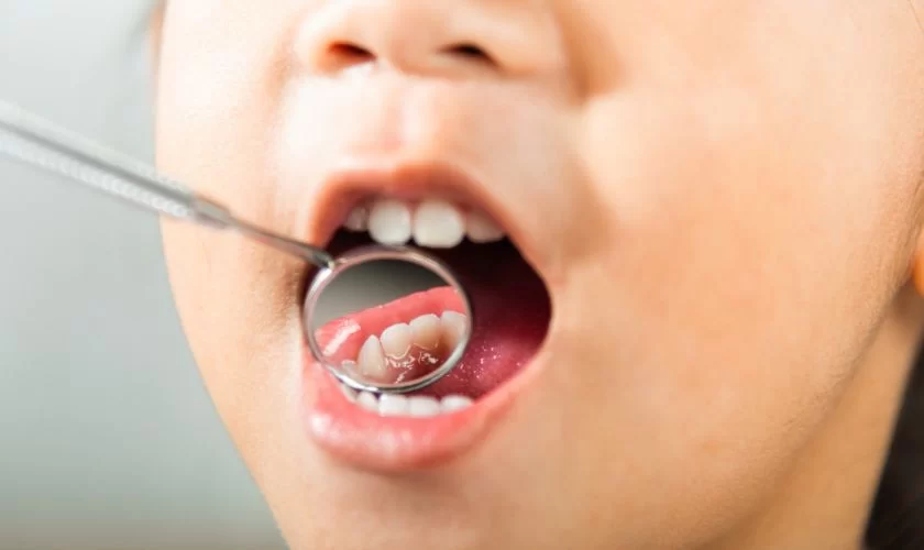 How to Avoid Cavities Naturally: Effective Tips and Habits