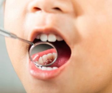 How to Avoid Cavities Naturally: Effective Tips and Habits